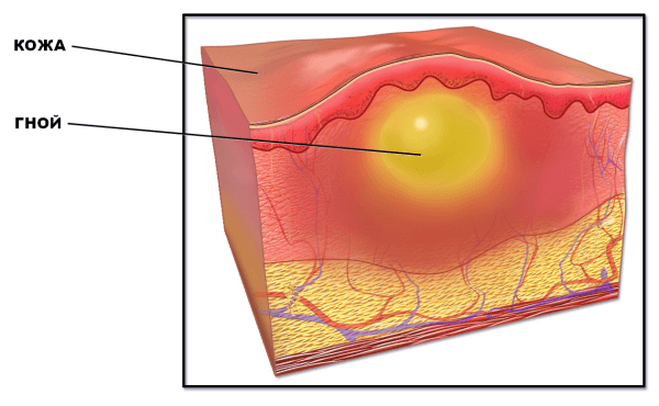 гнойная рана