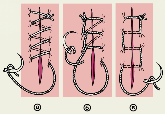 наложение шва на рану